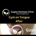 Cyst On Tongue After Gupta Homoeo Clinic