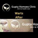 Warts After Gupta Homoeo Clinic