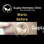 Warts Before Gupta Homoeo Clinic