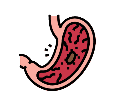 Gastric Ulcers