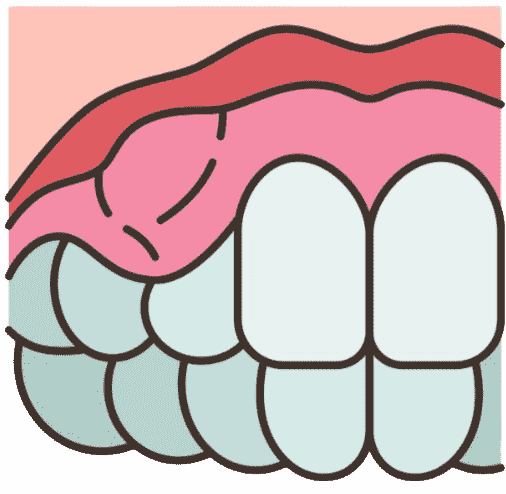 Swollen Gums