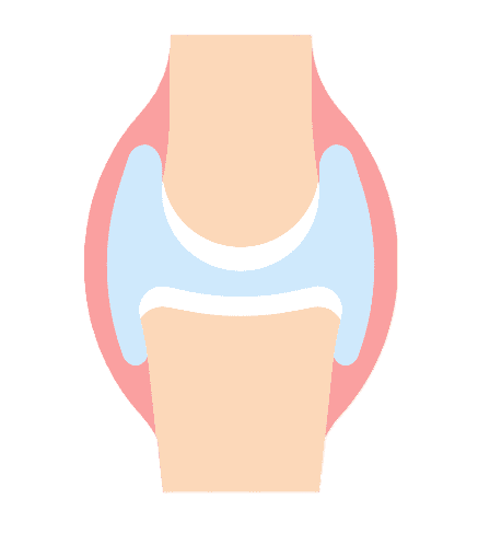 Synovitis