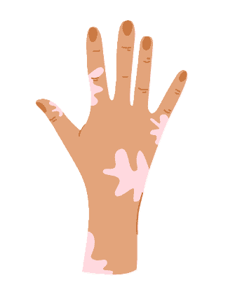 Vitiligo