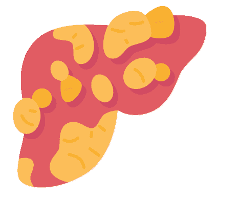 Fatty Liver