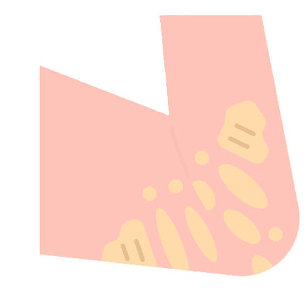 Psoriasis