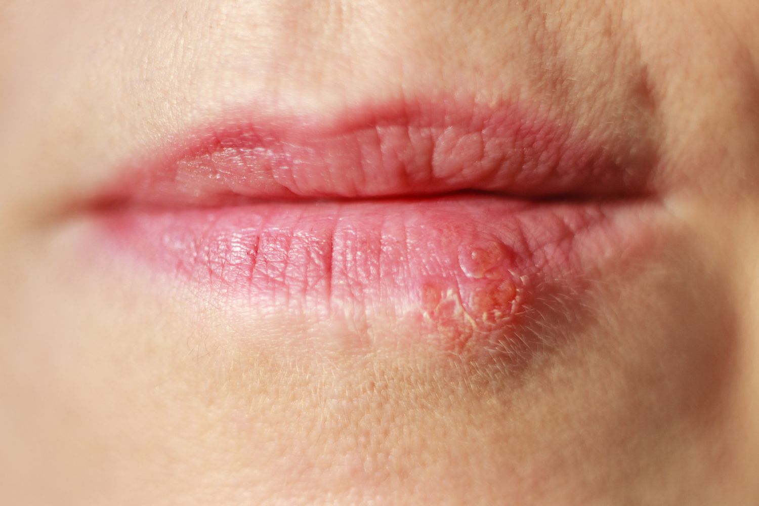 Herpes Vaccine 2025: The Breakthrough You’ve Been Waiting For