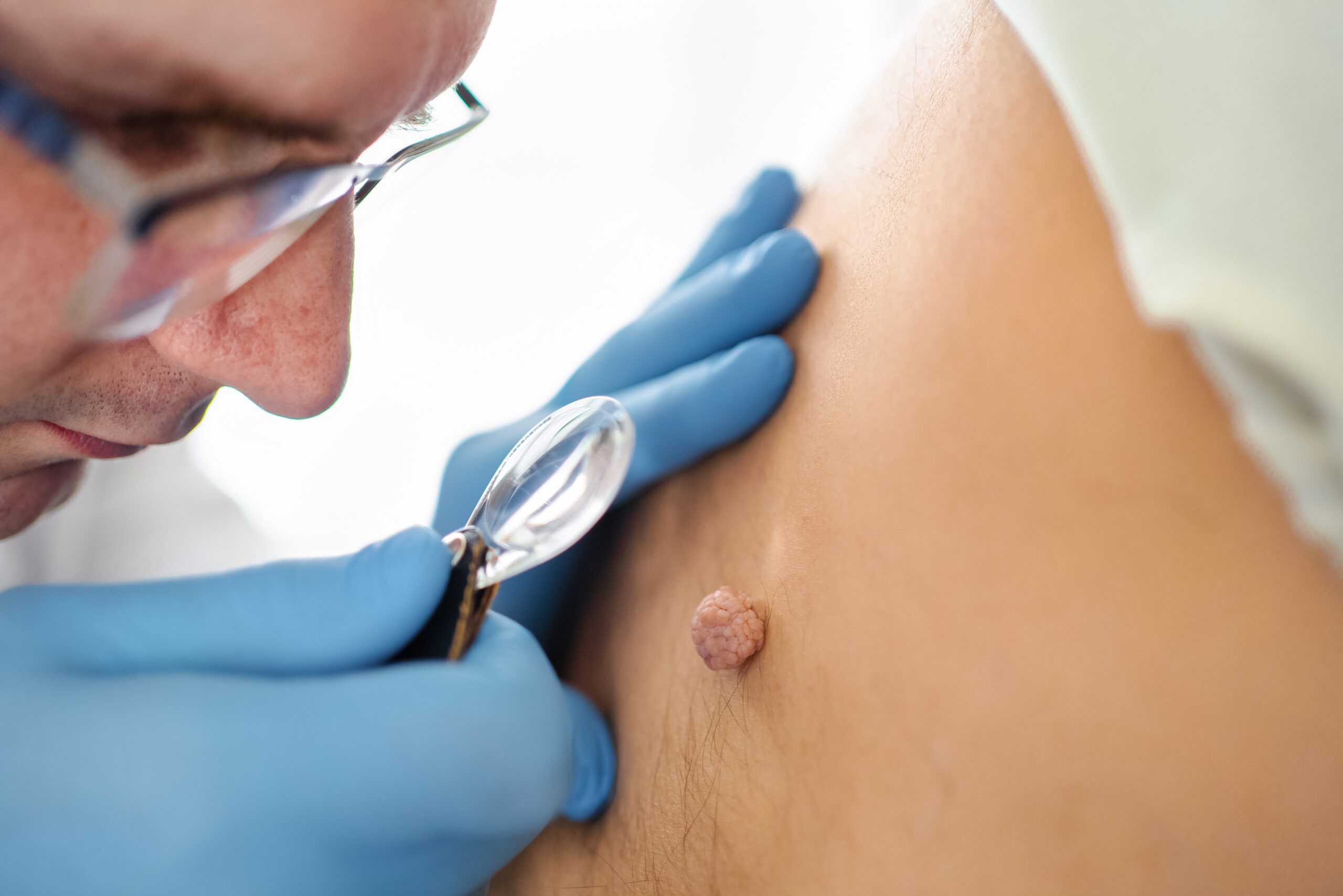 Preventing Recurrence: How Homeopathy Strengthens Immunity Against Genital Warts