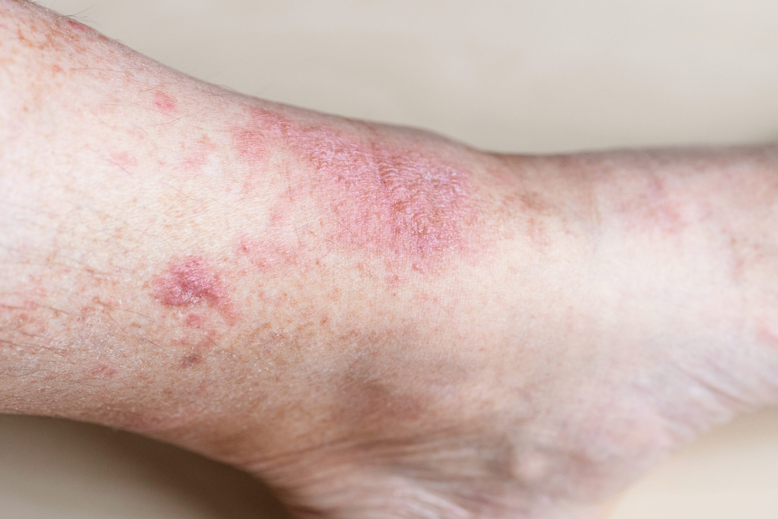The Impact of Climate Change on Fungal Infections: The Surge of Aspergillus Species and Public Health