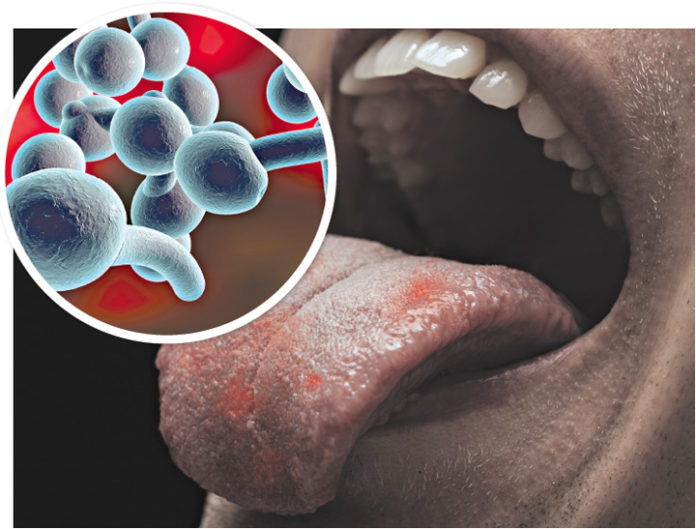 10 Surprising Signs of Candida Infection You Shouldn’t Ignore