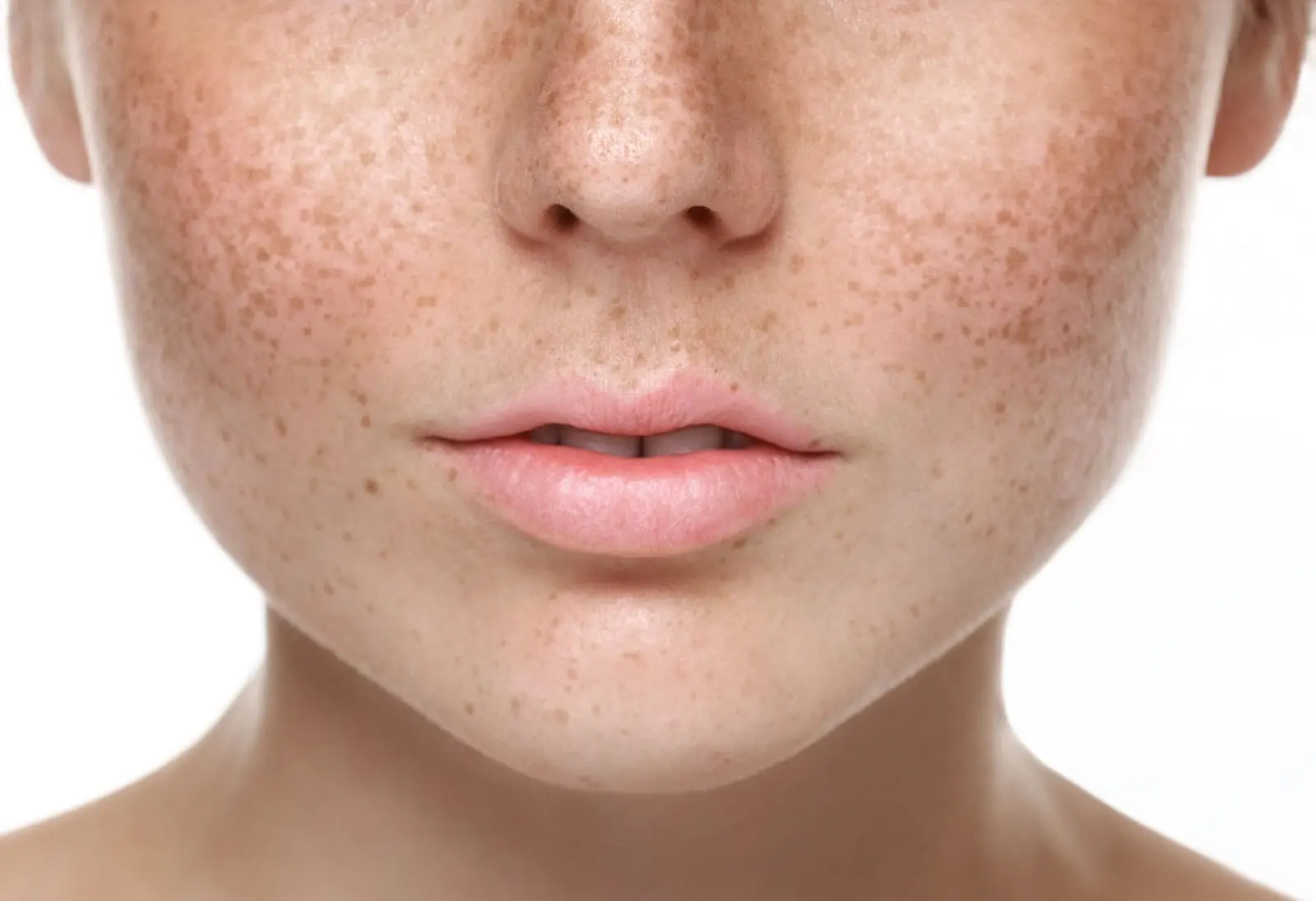 Lemon, Aloe, and More: Top 8 Home Remedies to Lighten Freckles