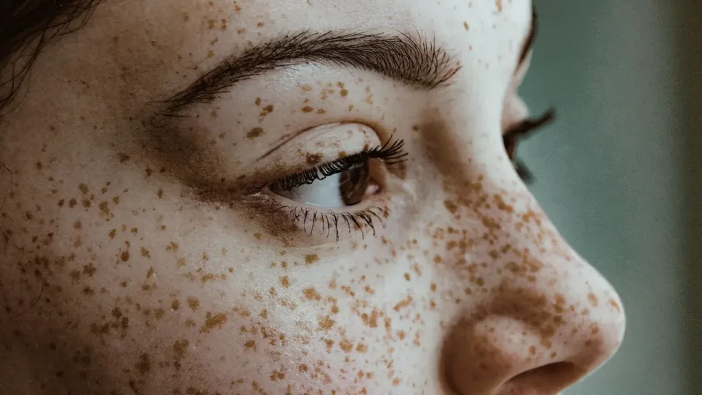 Close-up of a person's face, showing freckles and eye detail.
