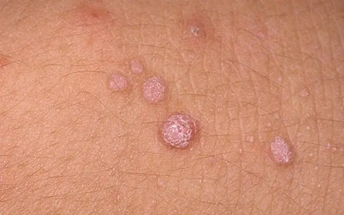 Close-up of skin with several seborrheic keratoses.