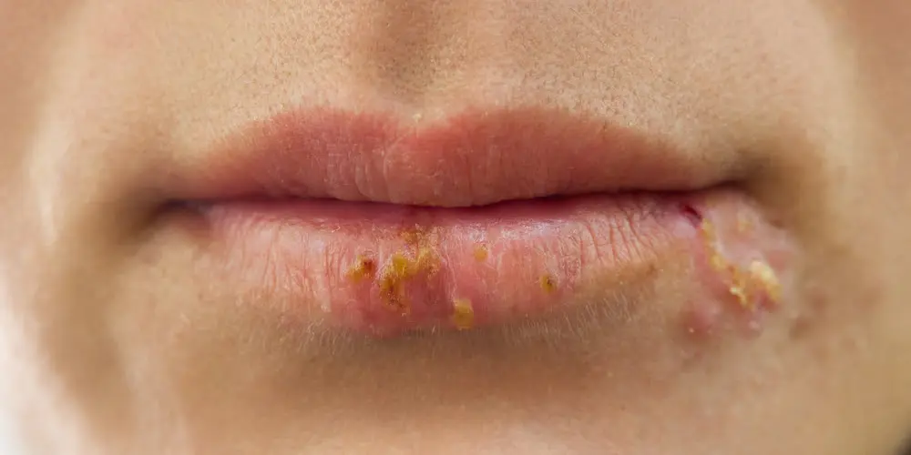 Close-up of a mouth with sores, possibly cold sores or herpes simplex.