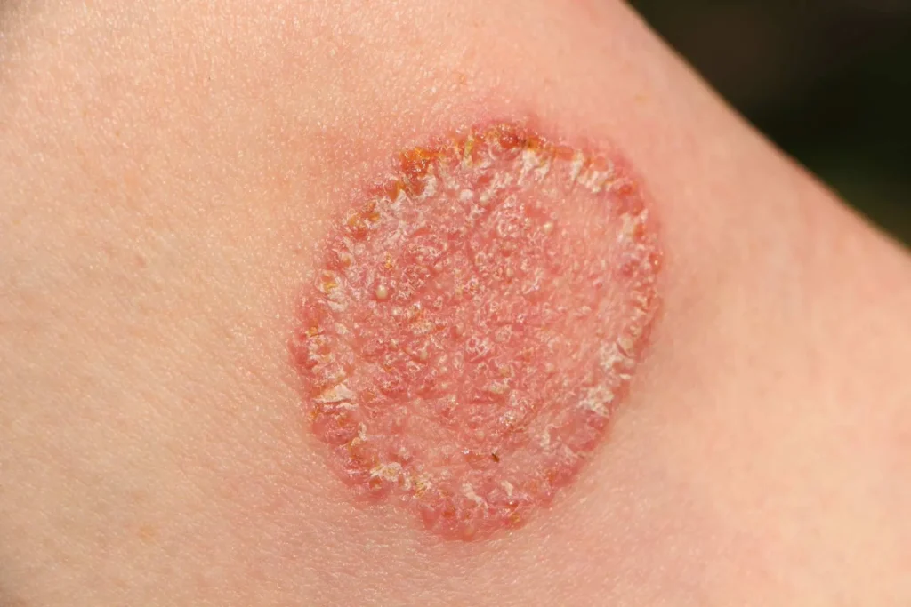 Close-up of a ring-shaped, scaly, red skin lesion.