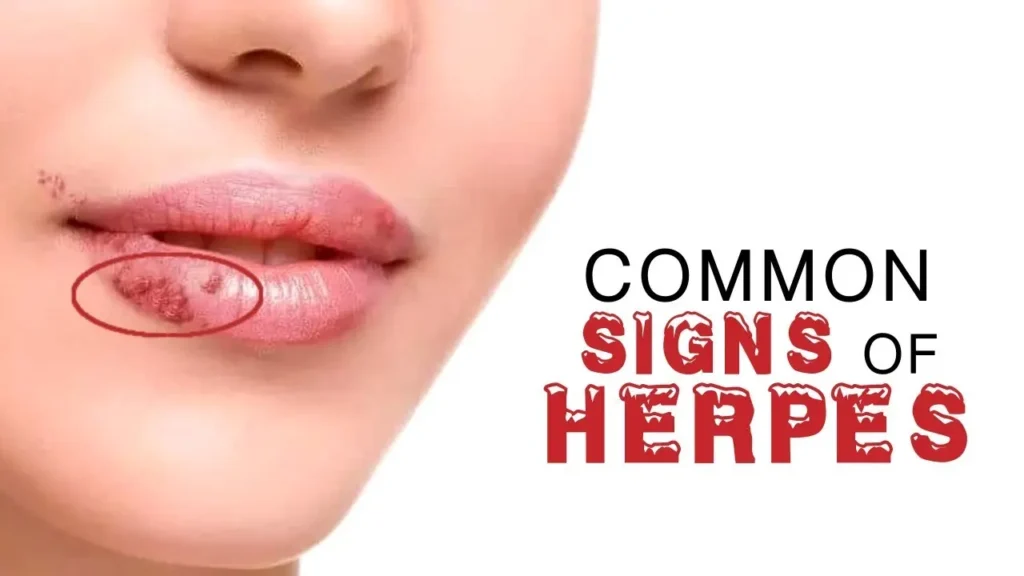 Close-up of herpes simplex sores on a lower lip.