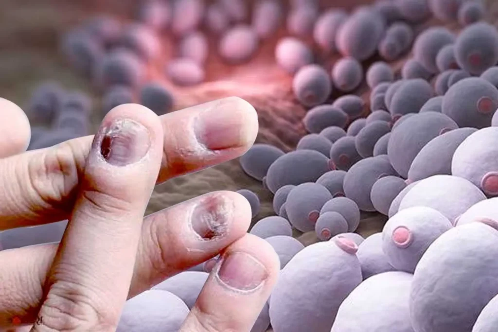 Close-up of fingers with fungal nail infection, alongside microscopic image of fungus.