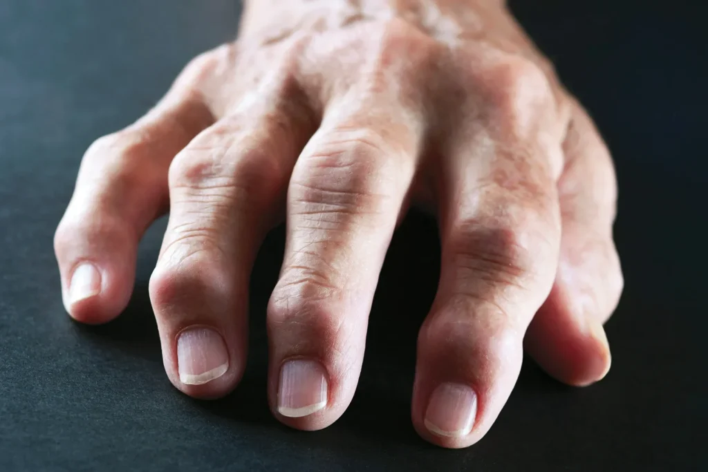 Close-up of a hand with severely deformed fingers, likely due to advanced rheumatoid arthritis.