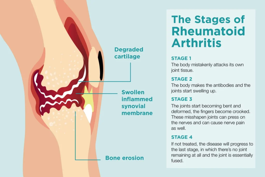 Medical illustration showing the stages of rheumatoid arthritis with labeled parts including degraded cartilage, swollen inflamed synovial membrane, and bone erosion. Text on the side describes four stages of disease progression.