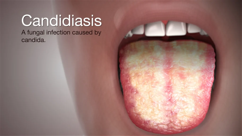 Medical illustration of oral candidiasis showing a human mouth with an open tongue covered in thick white and yellow fungal patches, caused by Candida infection.