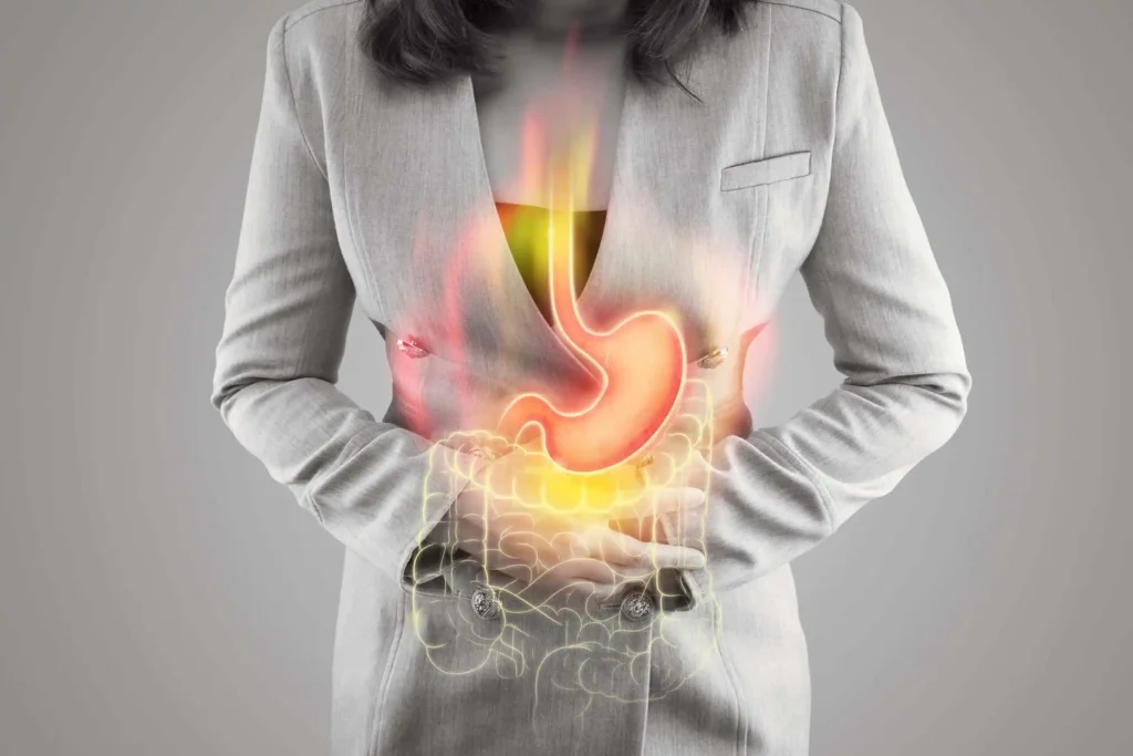Medical illustration showing an inflamed and ulcerated stomach lining, depicting the effects of prolonged acidity or peptic ulcers.
