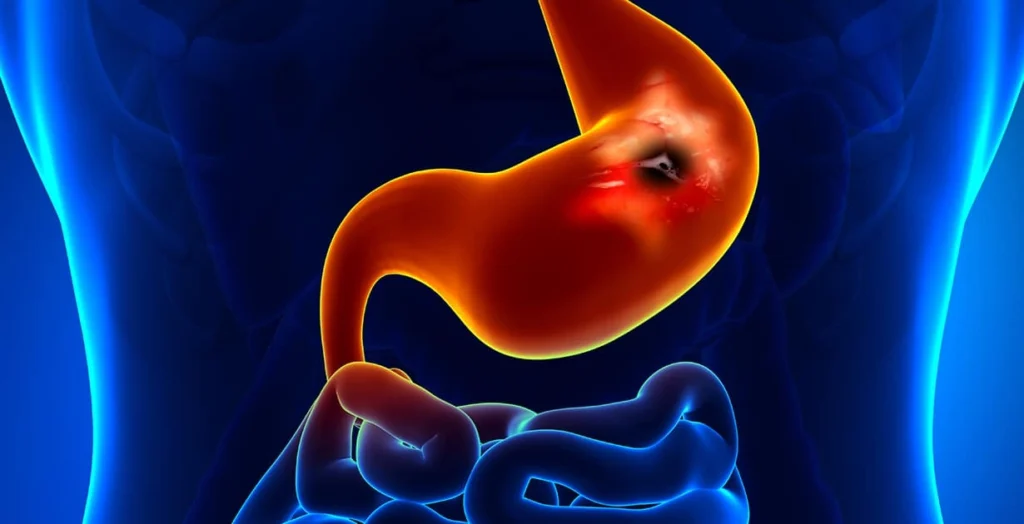 Businesswoman holding stomach, showing signs of heartburn or indigestion with a glowing stomach and intestinal tract overlay.