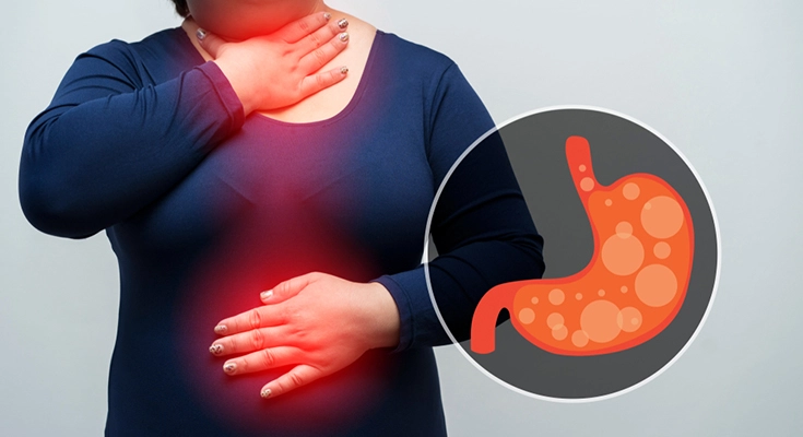 Illustration showing the inside of a human stomach with acid build-up, highlighting the cause of acidity. The words 'Cause of Acidity' are written on the left.