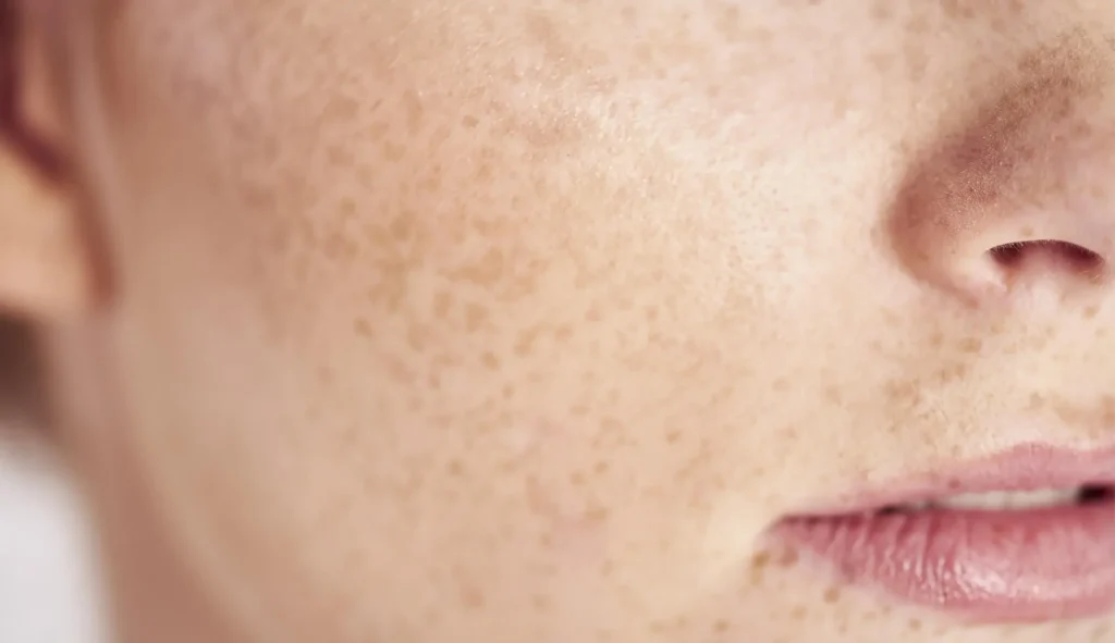 Close-up of freckled face showing part of nose and mouth.