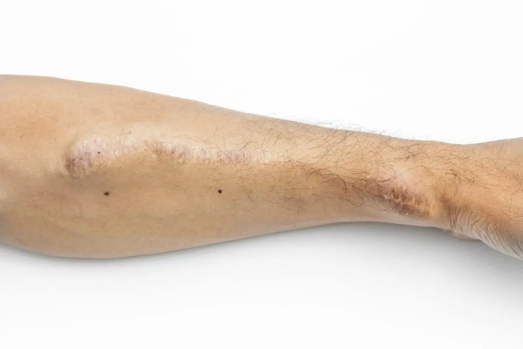 Close-up of a forearm showing long, healed scars.