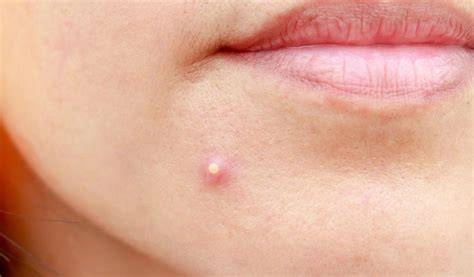 Preventing and Treating Vaginal Boils: A Complete Women’s Health Guide