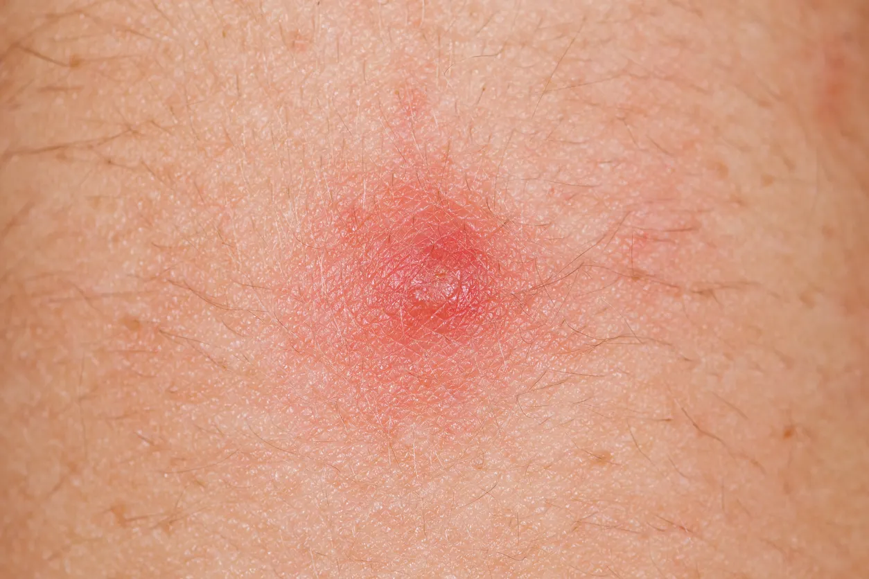 Summer Heat, Sweat & Boils: Practical Tips to Avoid This Painful Trio