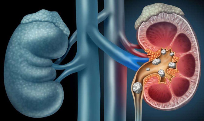 UTI vs. Kidney Stones: How to Tell the Difference and When to See a Doctor
